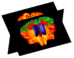 Subcortical structures with slice views, alternate view