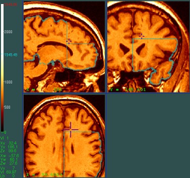 Edit slices superior to the axial cut and anterior to the coronal