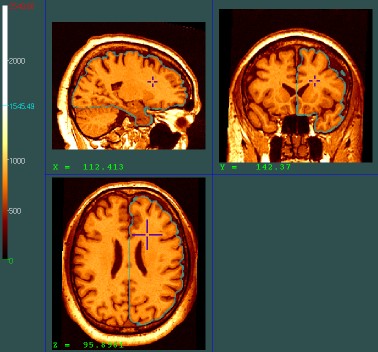 Scan object to volume shows a green outline around the MR volume