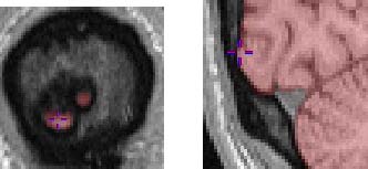 coronal and sagittal views of brain, posterior aspect