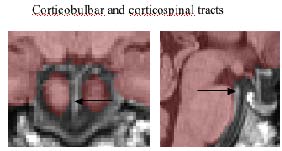 corticobulbar and corticospinal tracts