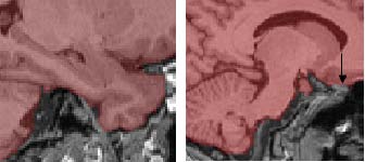 temporal lobe boundaries, sagittal view