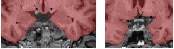 temporal lobe boundaries, coronal view