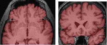 meninges and nerve tracts on edges of temporal lobe are not labeled