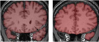 ending point of temporal lobe