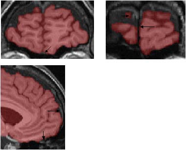 anterior frontal lobe