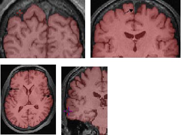 superior and lateral boundary of frontal lobe