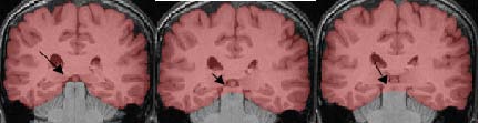 boundary between cerebrum and cerebellum.