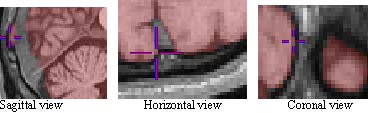 sagittal, axial, and coronal views of medial posterior brain regions