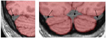 confluence of the sinuses in sagittal and coronal views