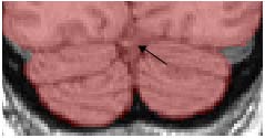 include the medial confluence of sinuses