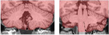 uneven cerebellar levels