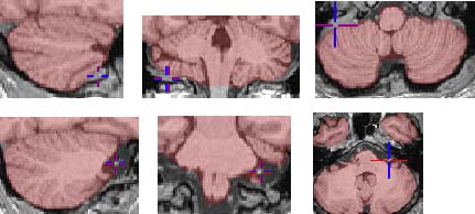 cerebellar boundary examples