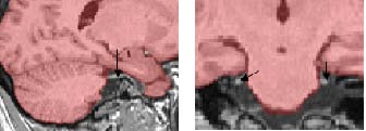 exclude the trigeminal nerve