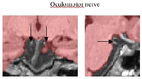 oculomotor nerve in coronal and sagittal views