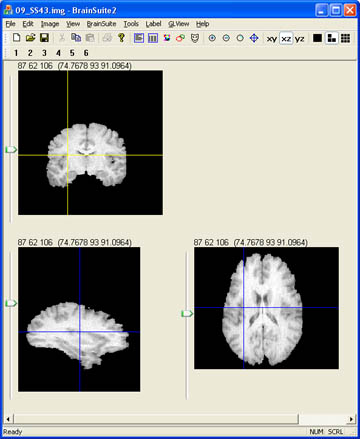 Skull stripped brain