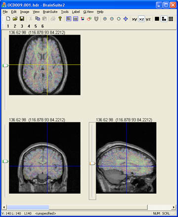 Skull stripped brain overlayed on whole volume