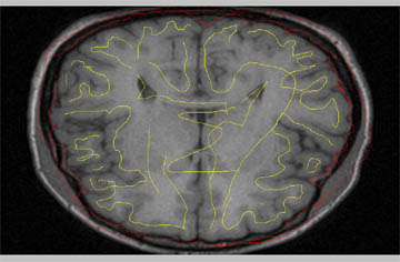 Contours on the ventricles