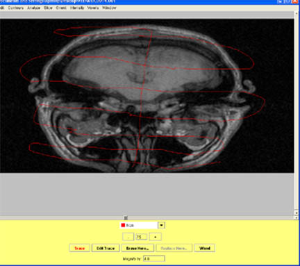 Marking non-brain tissue