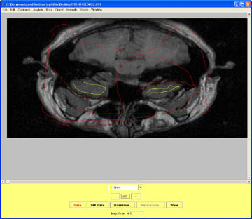 Be careful around the temporal lobe.