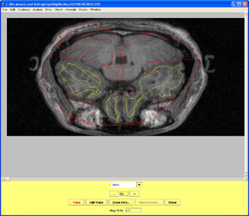 Masking the frontal and temporal lobes