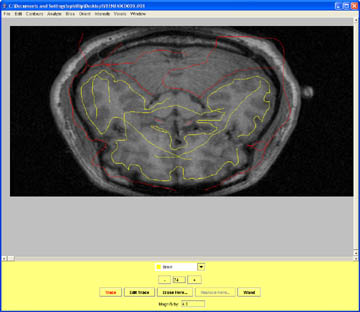 Mark out the optic nerve tracts