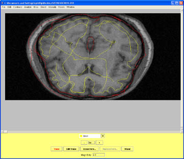 Marking CSF at the midline