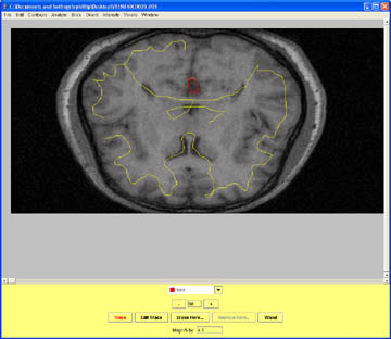 Marking CSF at the midline