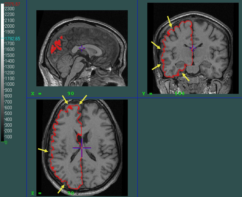 overthresholded object scanned to minc volume